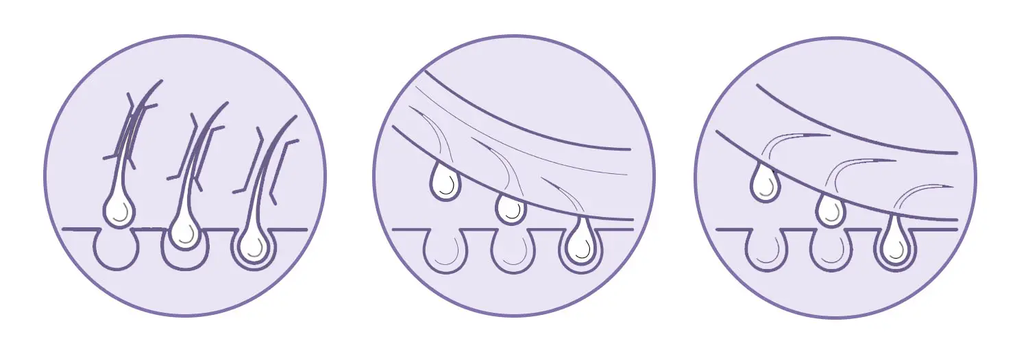 Depilation und Epilation